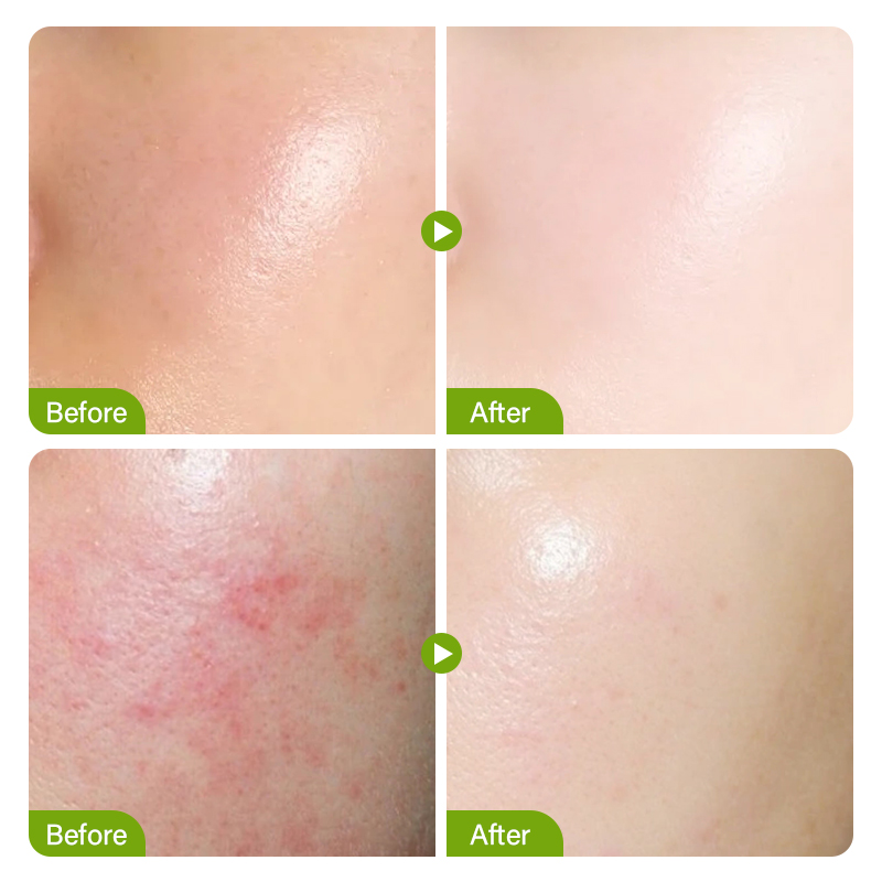 Salicylic Acid Acne Treatment  - огляд і ціна Salicylic Acid Cleanser